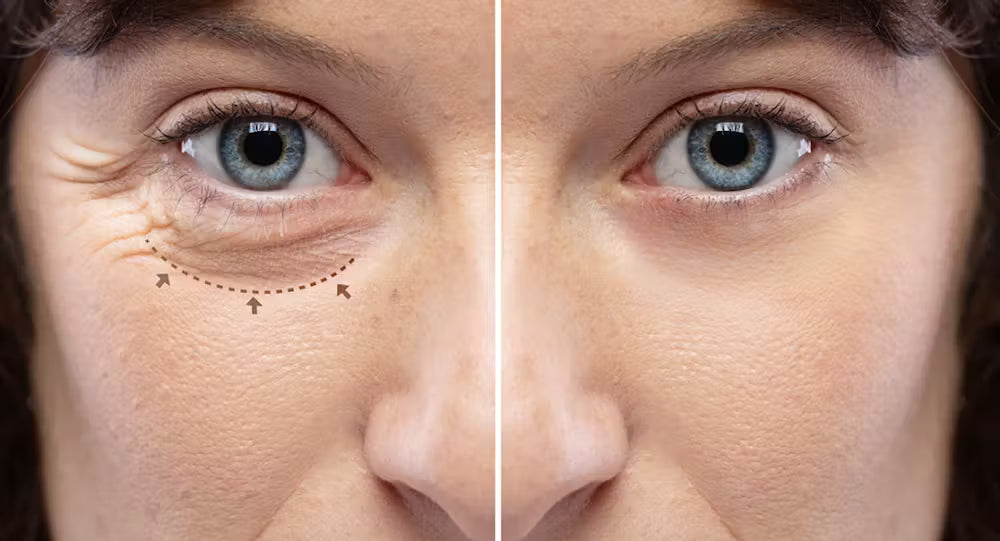 Face Surgery-Blepharoplasty
