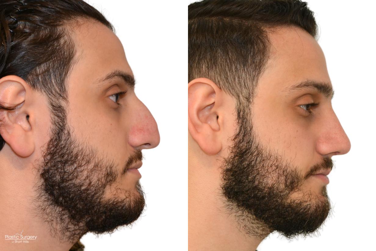 Face Surgery-Rhinoplasty