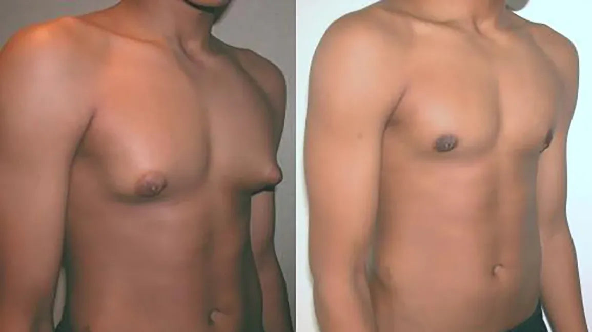 BREAST SURGERY-Gynecomastia