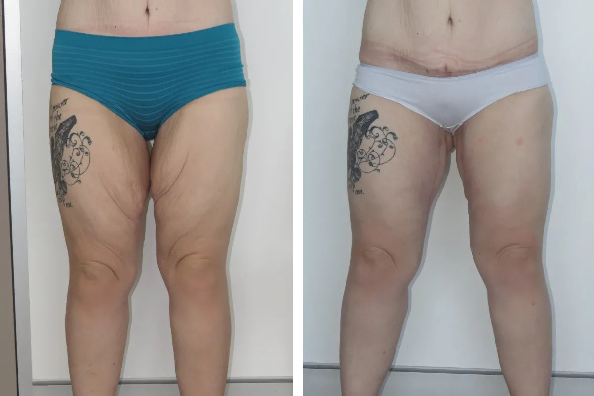 Body Contouring-Thigh lift