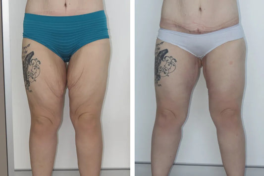 Body Contouring-Thigh lift