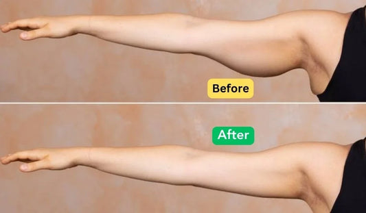 Body Contouring-Arm lift