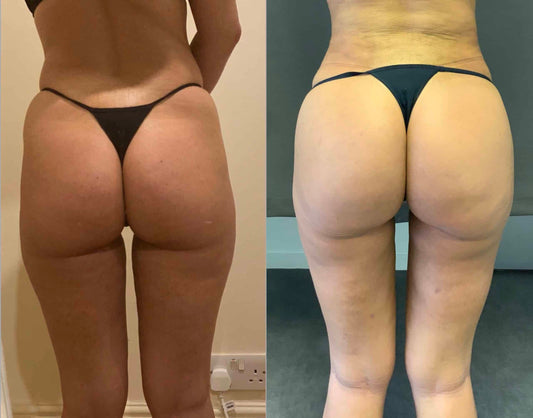 Body Contouring-Buttock lipofilling