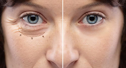 Face Surgery-Blepharoplasty
