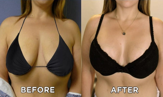 BREAST SURGERY-Lifting