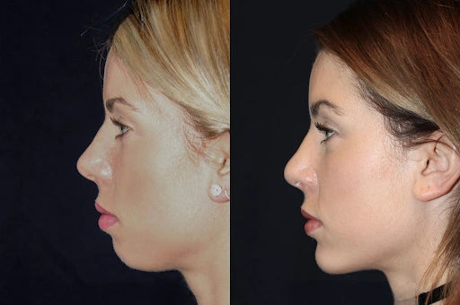 Face Surgery-Genioplasty