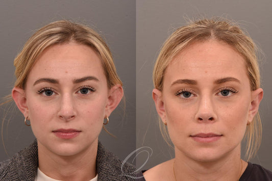 Face Surgery-Otoplasty