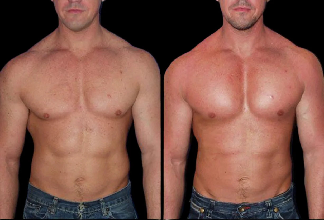 BREAST SURGERY-Pectoral implants