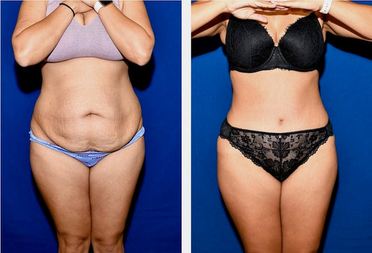Body Contouring-Abdominoplasty