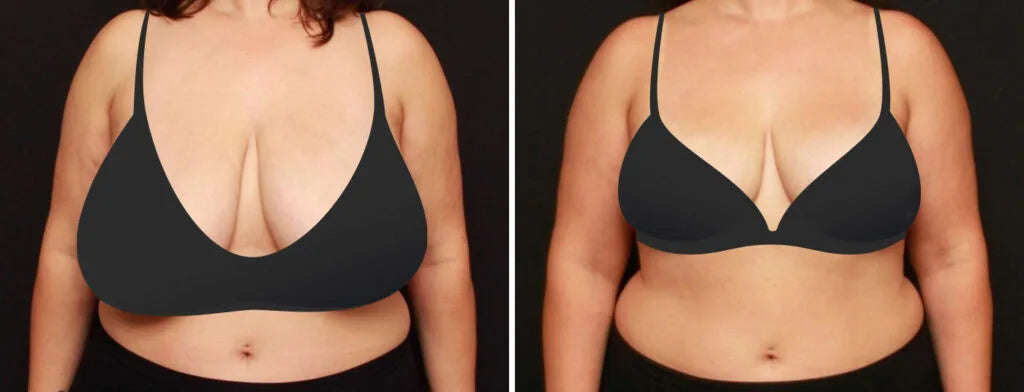 BREAST SURGERY-Reduction