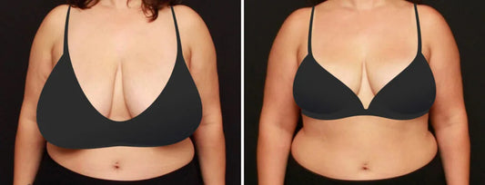 BREAST SURGERY-Reduction