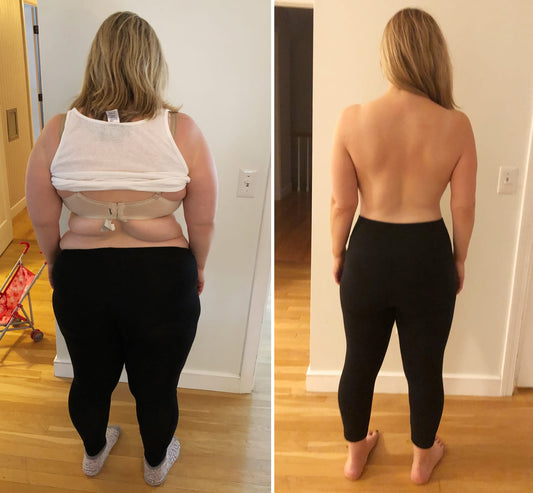 Bariatric Surgery-Sleeve